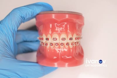Achieving A Fashionable Smile With Sky Blue Braces
