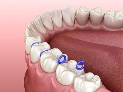 What are Rubber Spacers for Teeth?