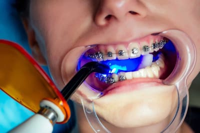 Is Hawley Orthodontics the Solution for Open Bite Before and After?