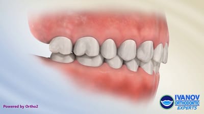 Advantages of Invisalign for Kids: Exploring Types of Rubber Bands for Braces