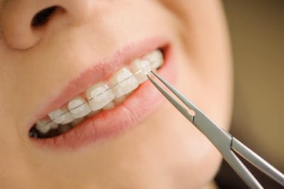Why Choose Blue Hues for Your Braces?