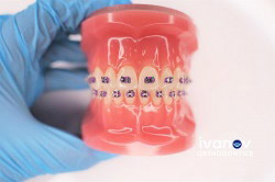 What Are the Advantages of Braces for Kids?
