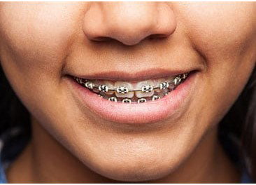 What Are The Significant Causes Of Bottom Teeth Braces?