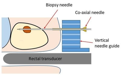 Prostate biopsy (transperineal) image