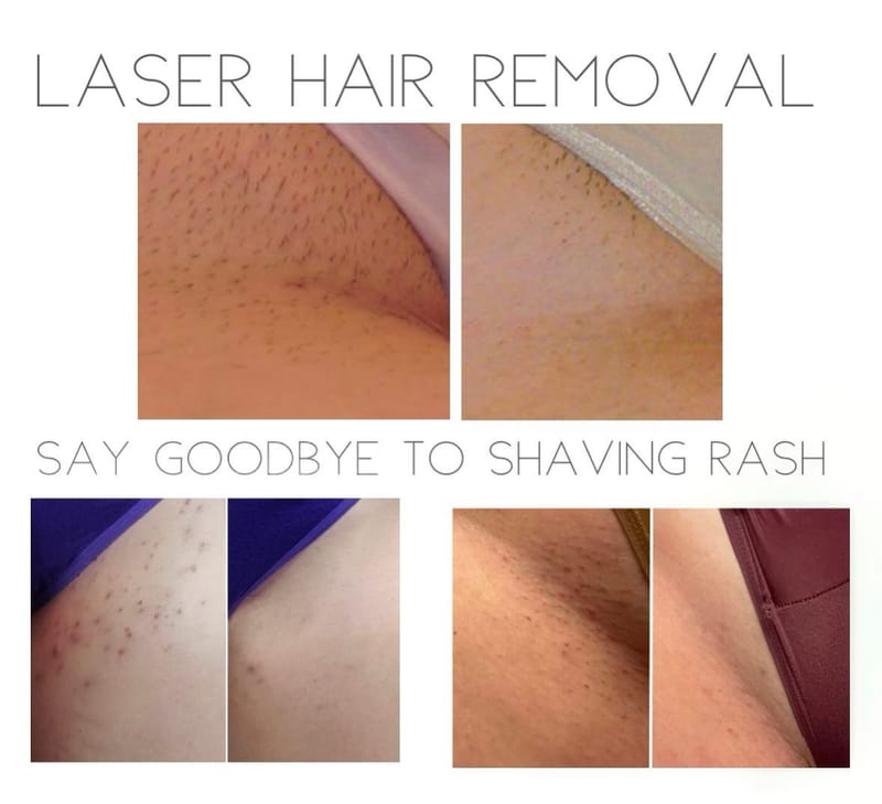 Laser Hair and Tattoo Removal