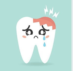What is tooth decay?