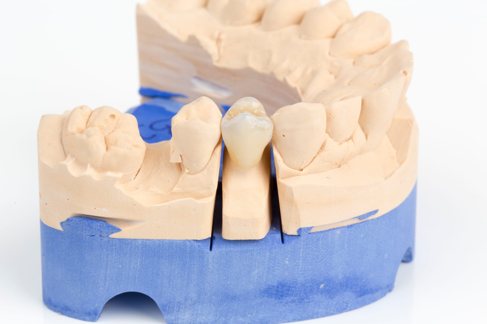 Inlays, Kronen, Brücken