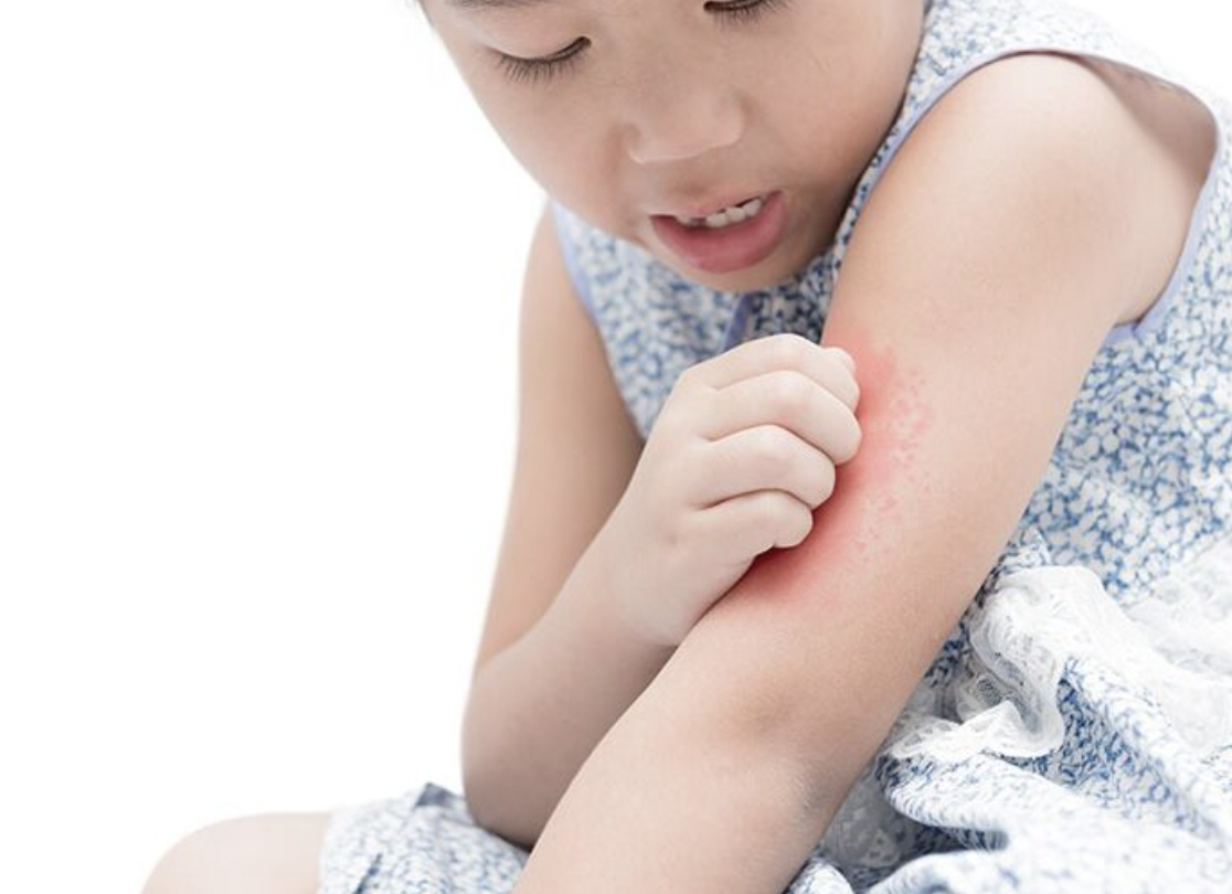 HOW TO MANAGE HIVES IN CHILDREN