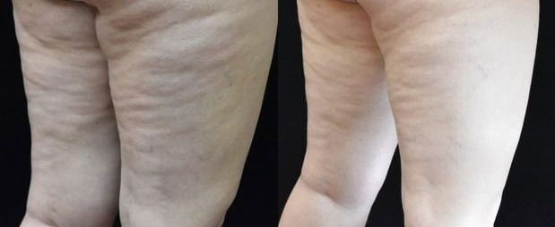 reduction of cellulite appearance