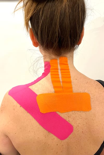 Kinesiotape terápia image