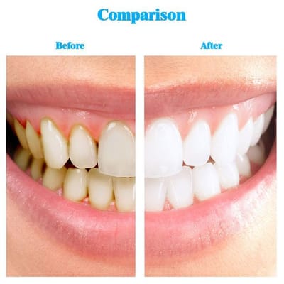 What to Consider When Buying the Best Teeth Whitening Kit