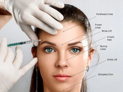 Botox Anti-Wrinkle Injection