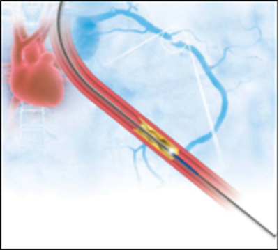 A Novel Tool For Diagnosis And Treatment of Heart Disease