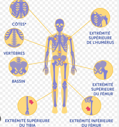 Quels sont les facteurs de risque de fracture ?  image