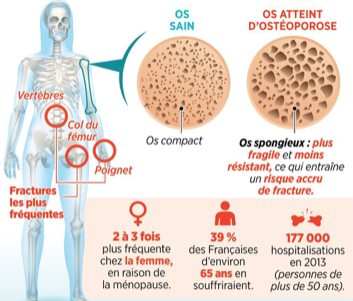 Qu'est-ce que l'ostéoporose ? image