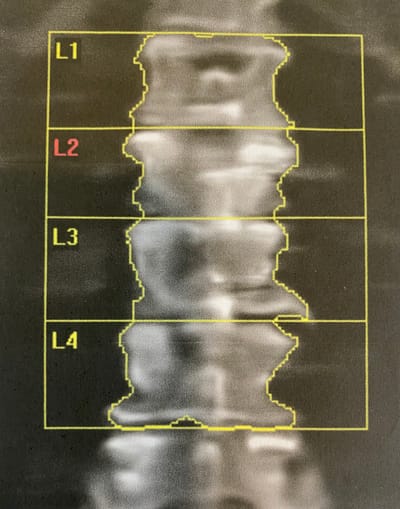 Comment interpréter les résultats de l’ostéodensitométrie  ? image