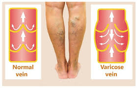 Varicosis