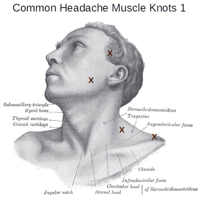 Myofascial Trigger Points (MFTPs) - Common locations and how to treat them