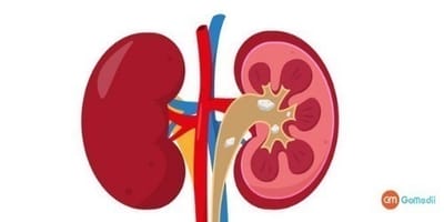 Changes in Quality Of Life after Kidney Transplantation