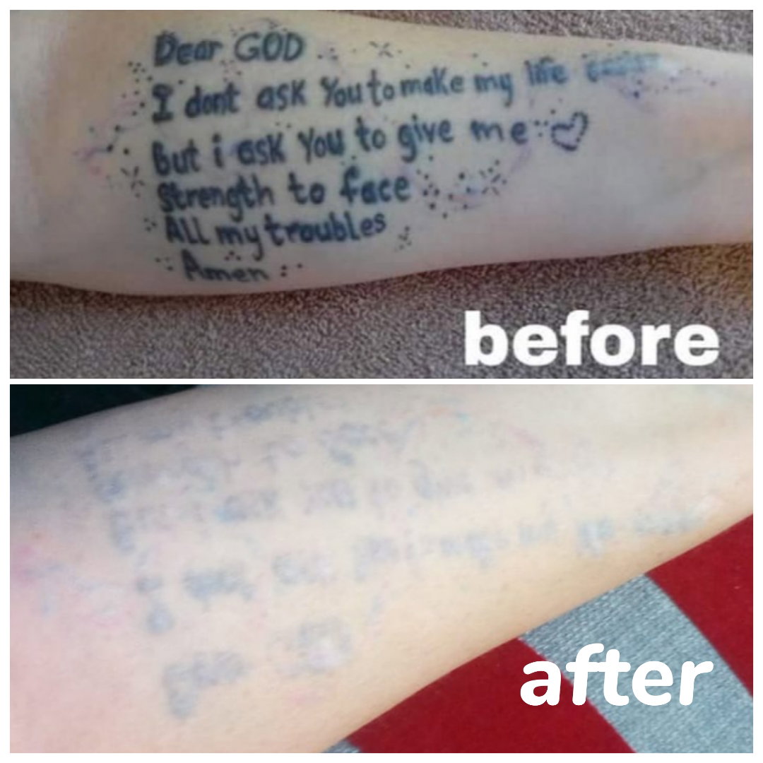 Tattoo removal