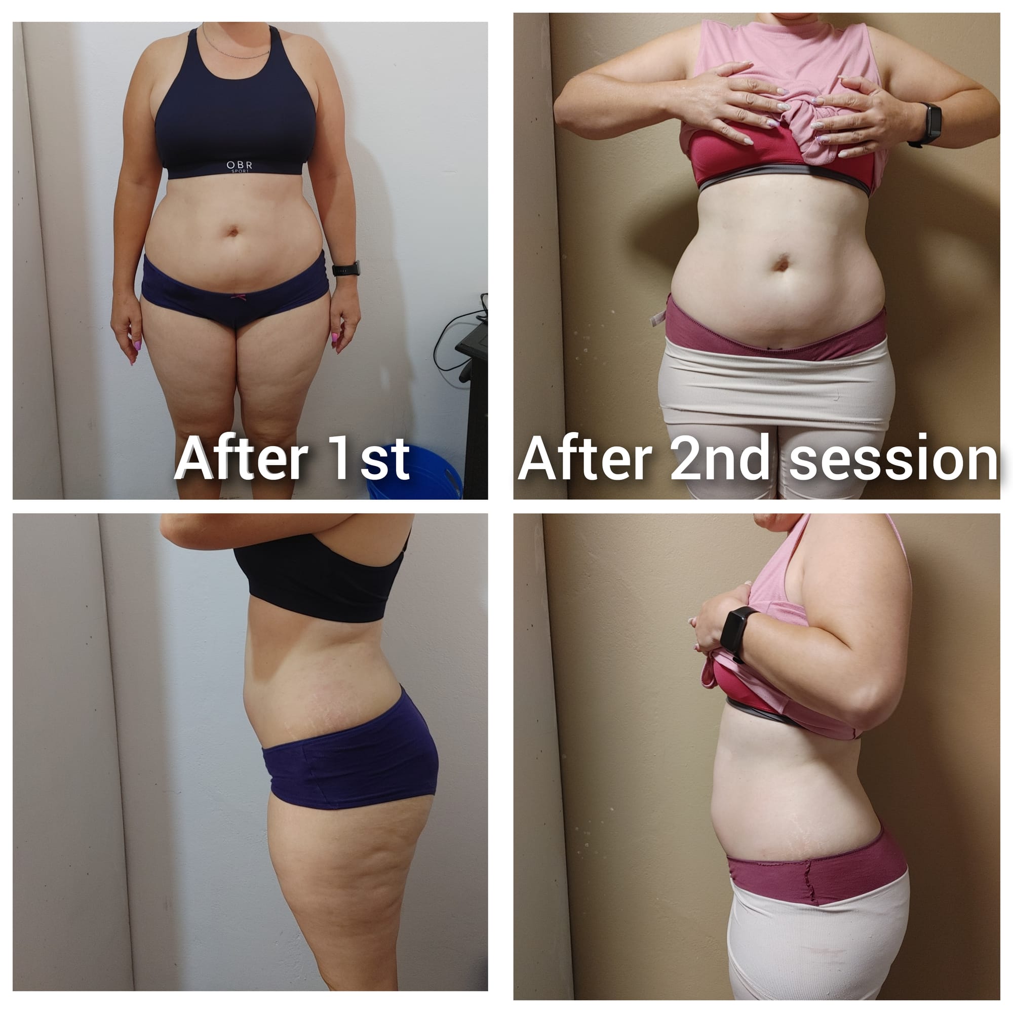 Laser Lipo and cavitation with RF thightening