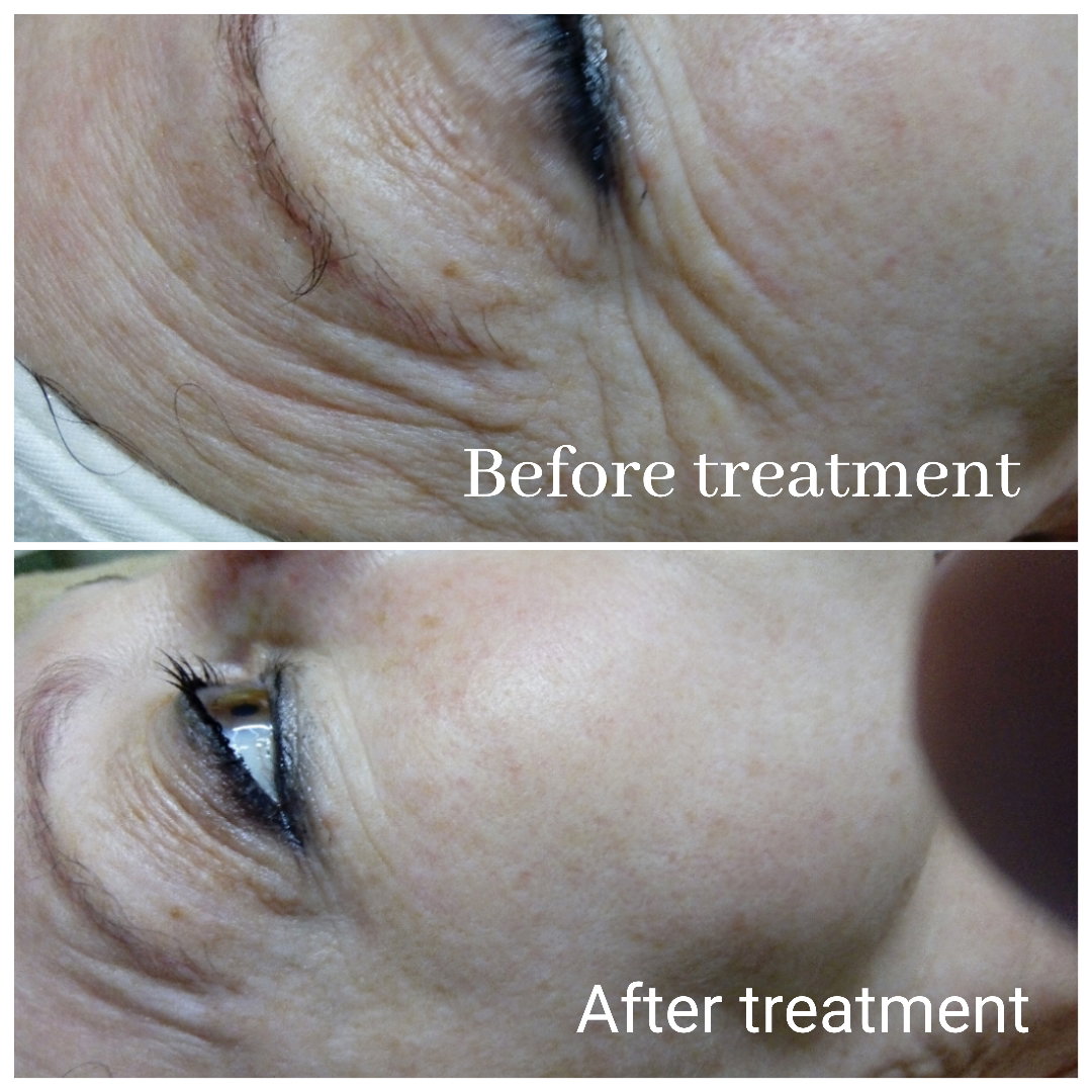 Black diamond laser facial
