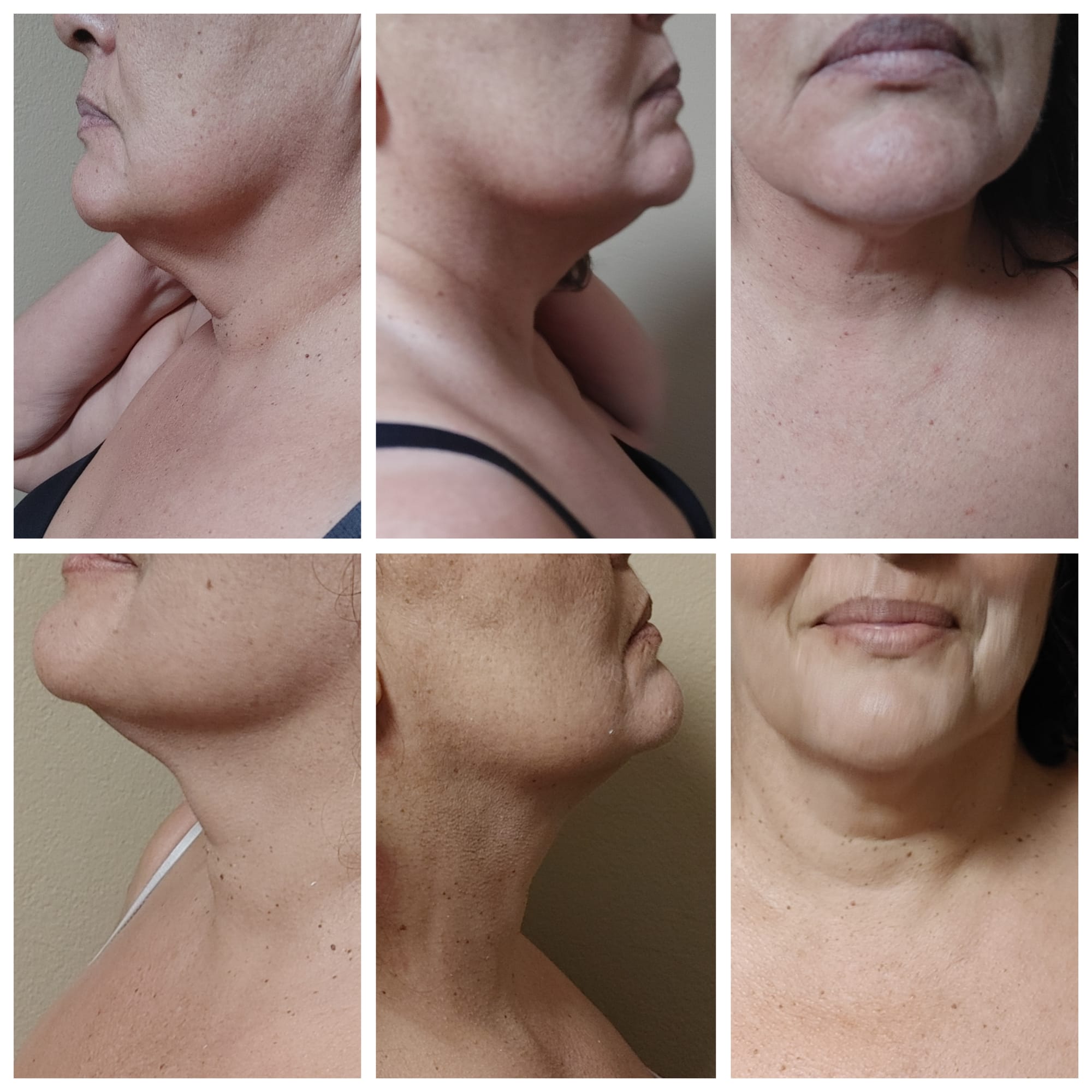 Neck and Jowell rejuvenation and tightening using Radio Frequency