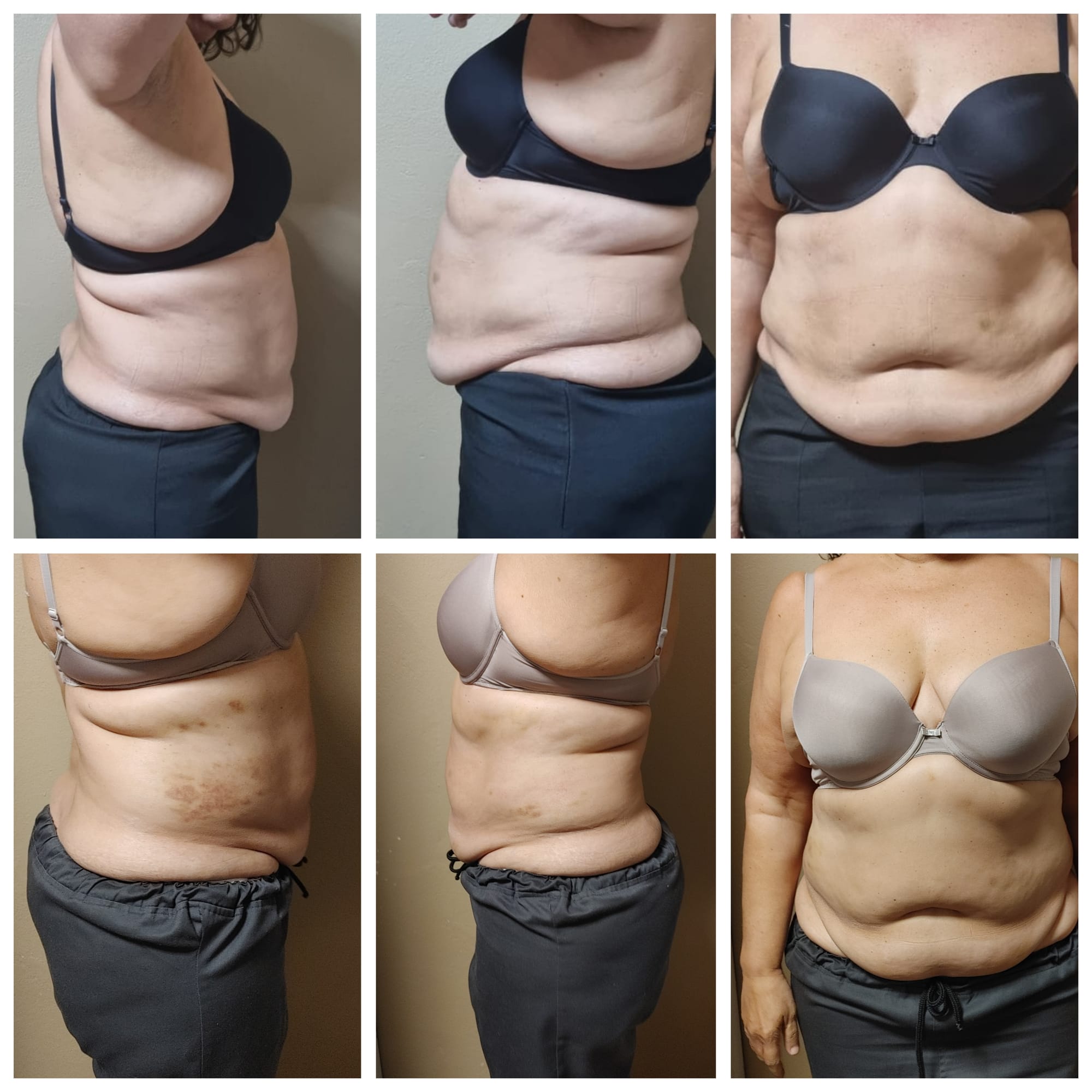 Laser lipo with cavitation and RF