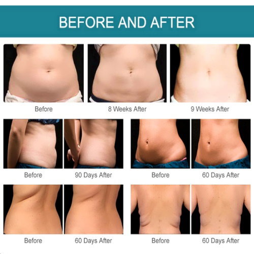 Non- Invasive lipo , Cavitation &amp; RF