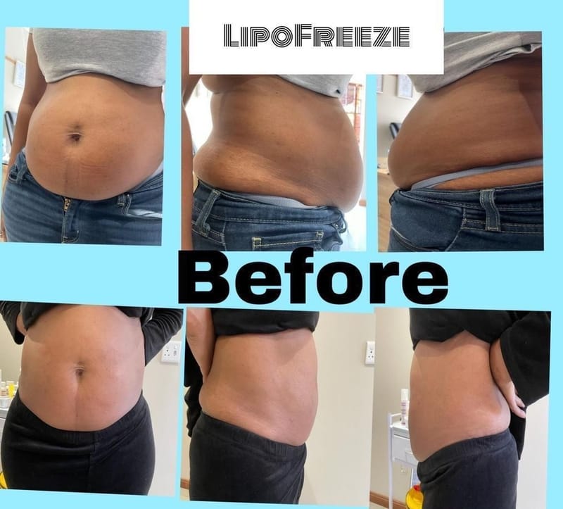 Lipo Freeze &amp; Lipo Slimming Injections