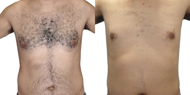 Laser Hair removal