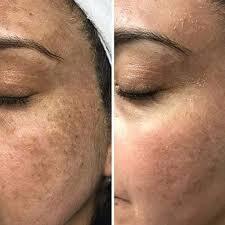 Chemical Peel - Non TCA