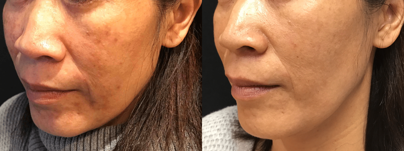 JAG LASER PIGMENTATION TREATMENT