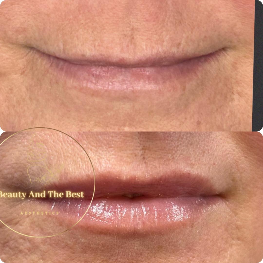 Lip Restoration