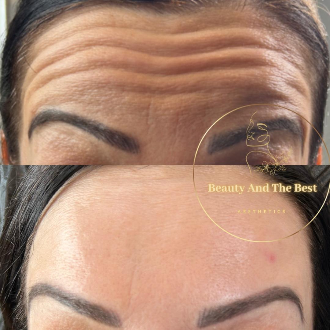 Ant-Wrinkle Treatment