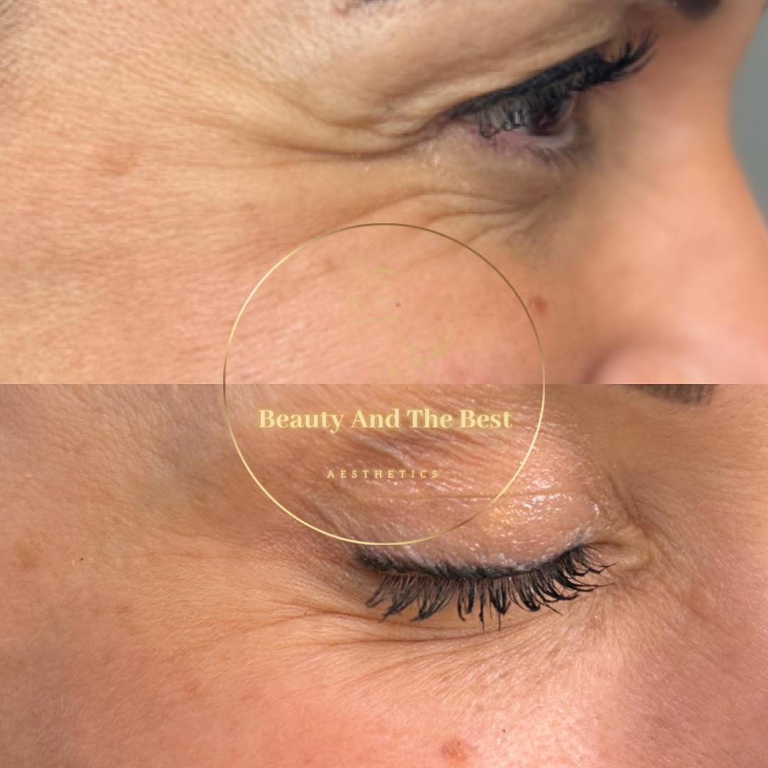 Ant-Wrinkle Treatment