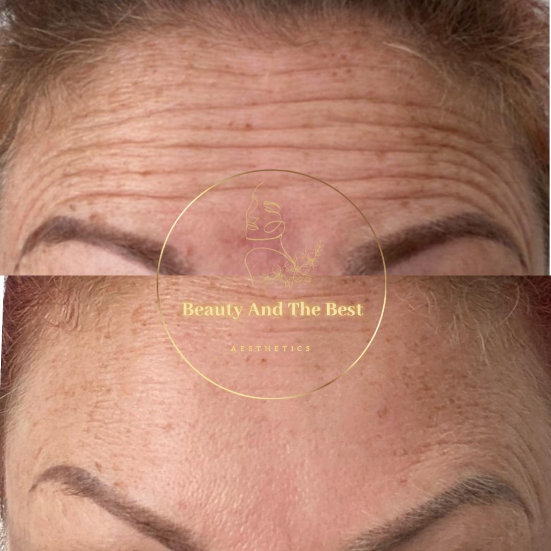 Ant-Wrinkle Treatment
