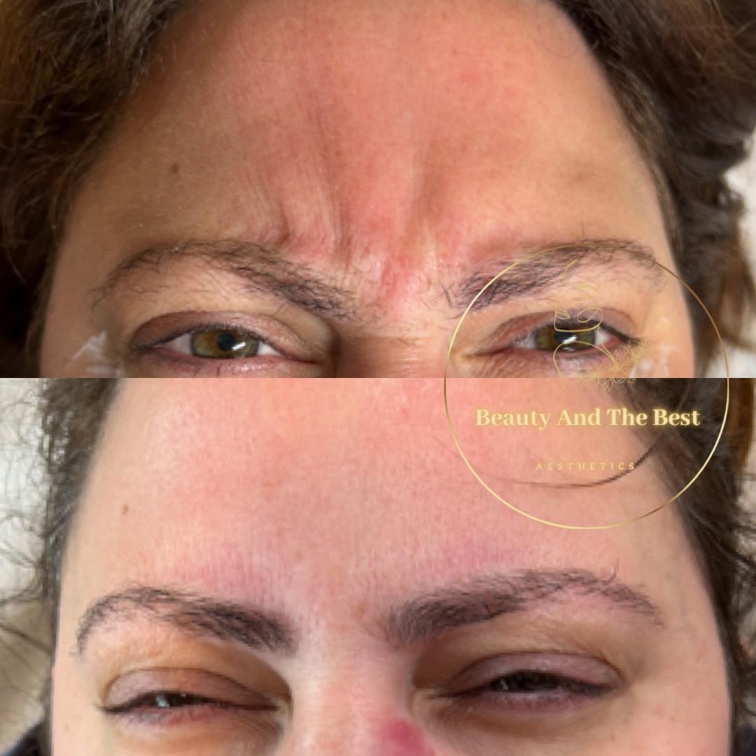 Ant-Wrinkle Treatment