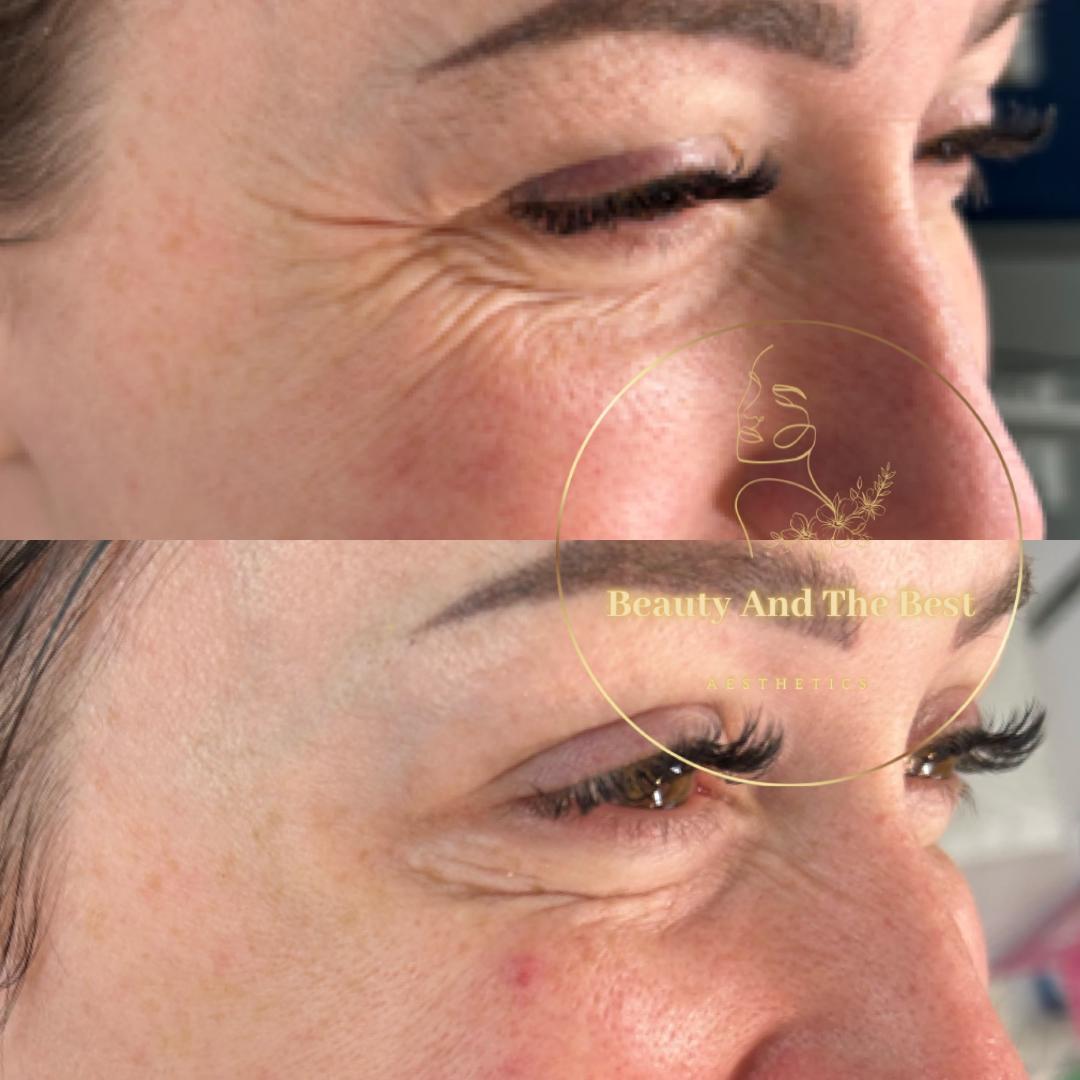 Ant-Wrinkle Treatment