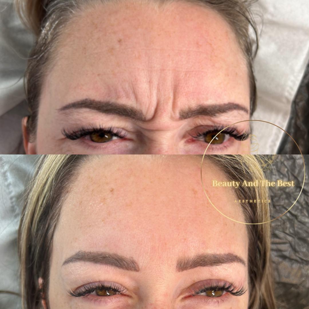Ant-Wrinkle Treatment