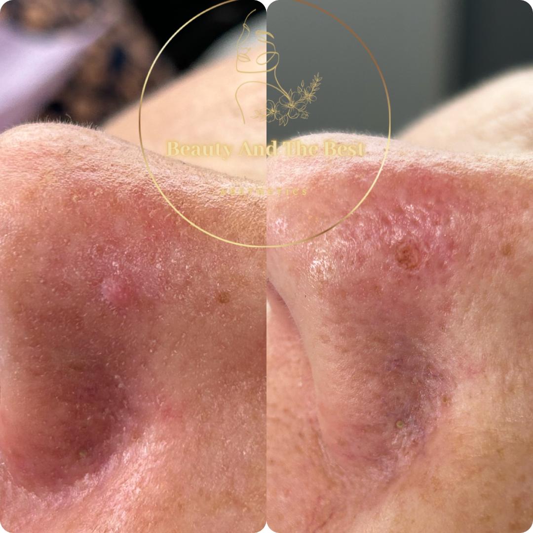 Blemish Removal