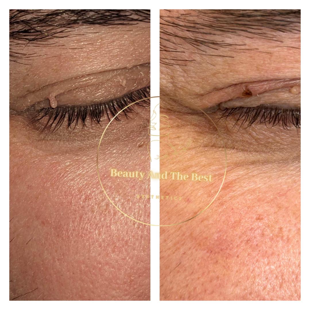 Skin Tag Removal