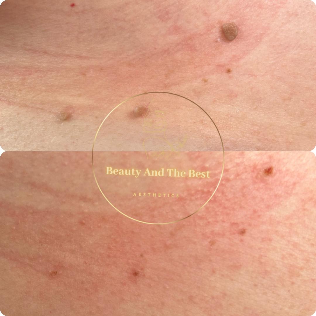 Mole Removal