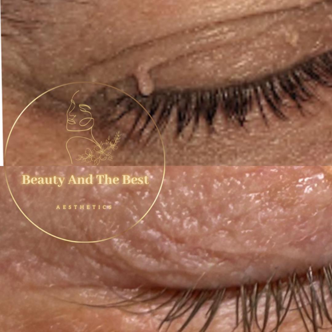 Skin Tag Removal