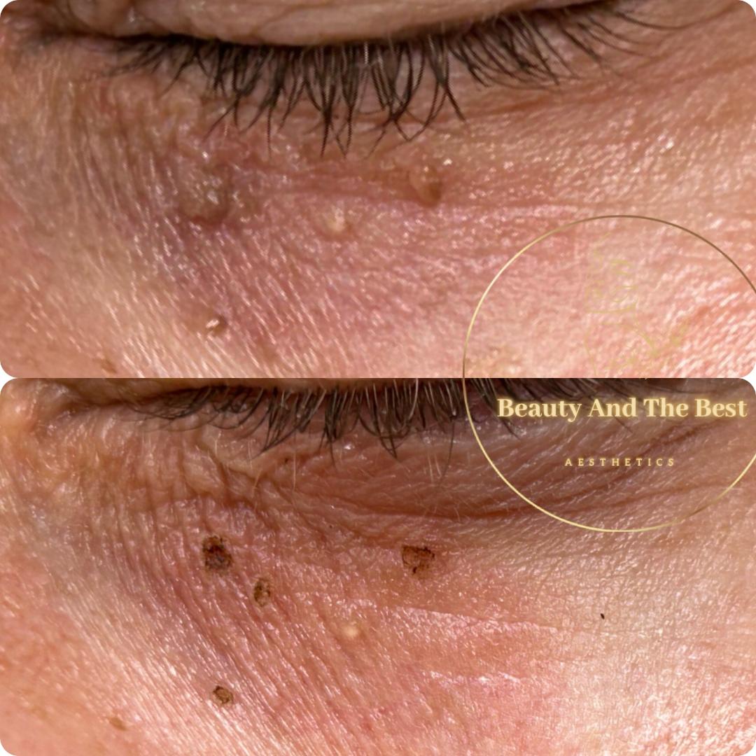 Skin Tag Removal
