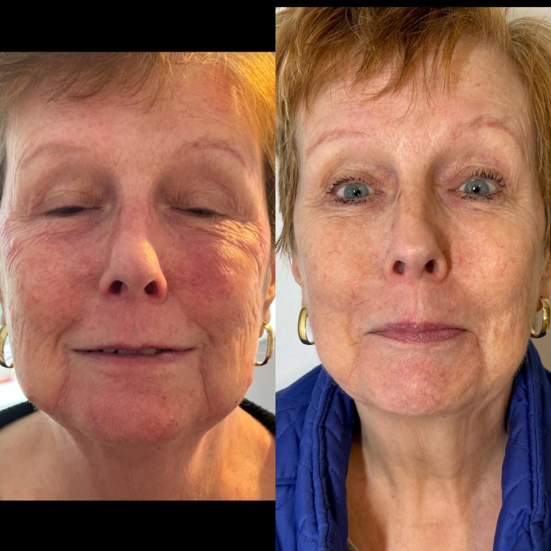 Skin Booster