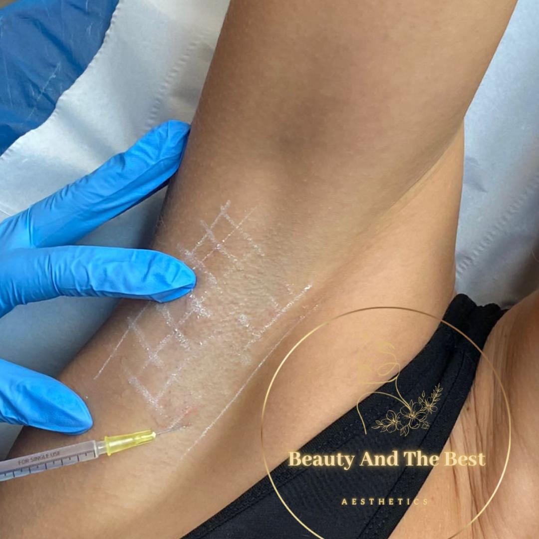 Sweat Gland Treatment