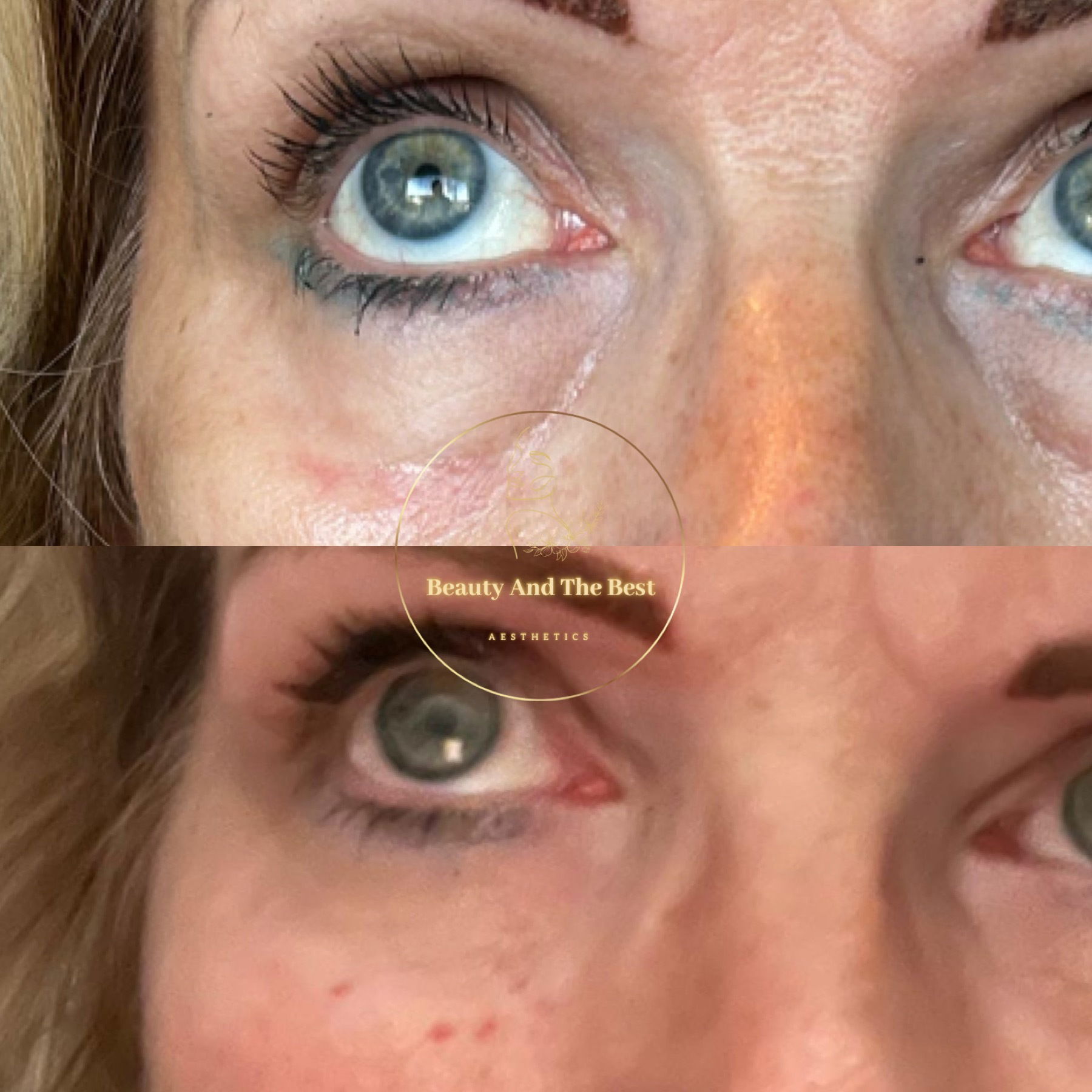 Derma Eye.