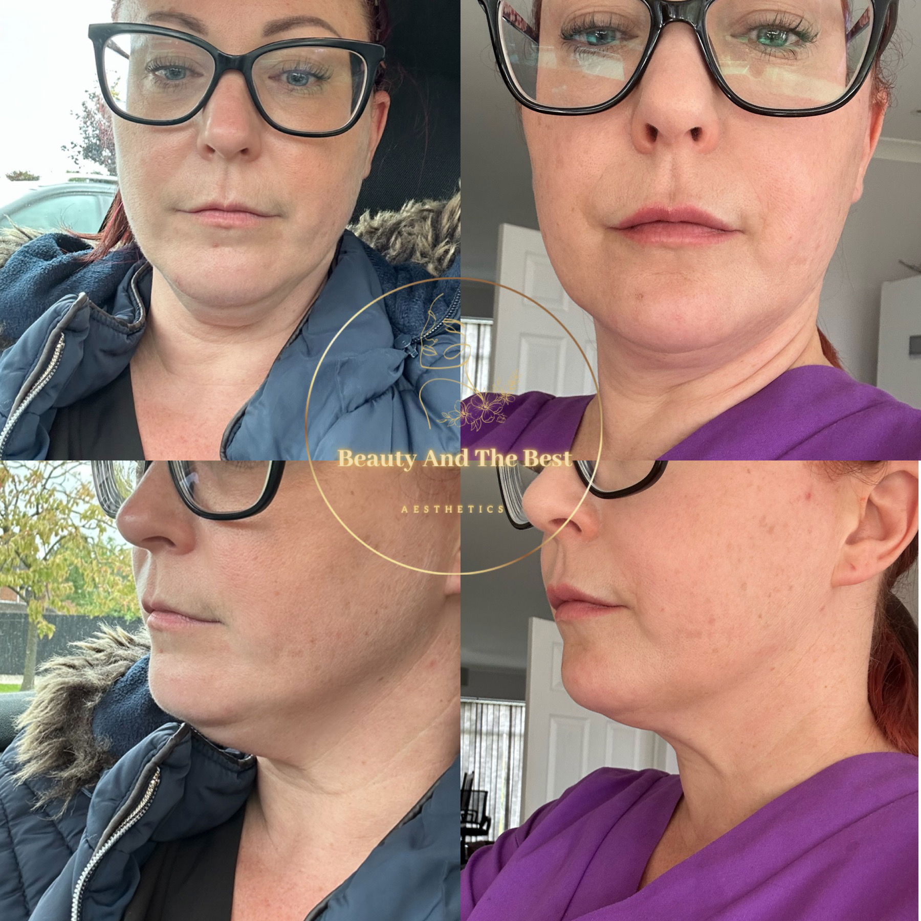 Lemon Bottle Fat Dissolve-Chin