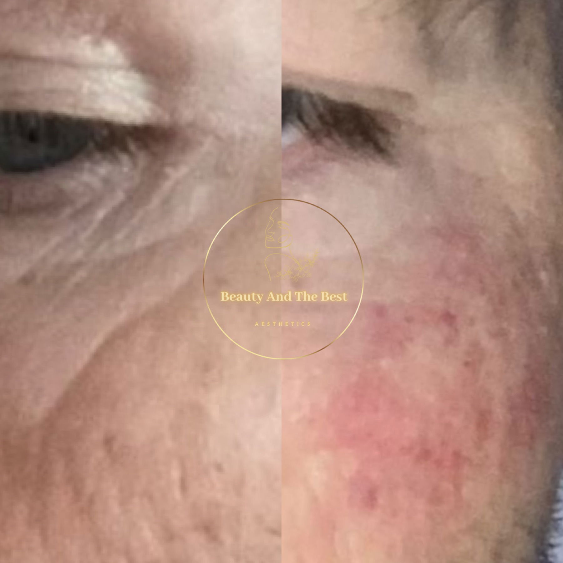 Skin Booster